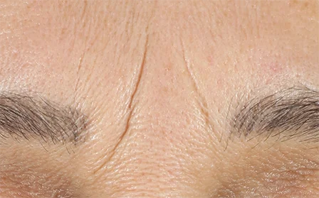 Before and after Youth expert treatment lion wrinkle