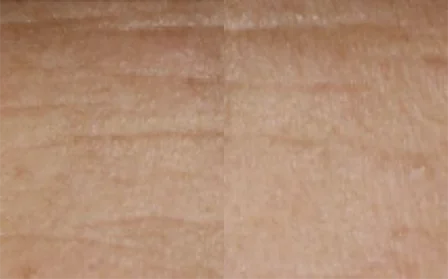 Before and after Youth expert treatment forehead